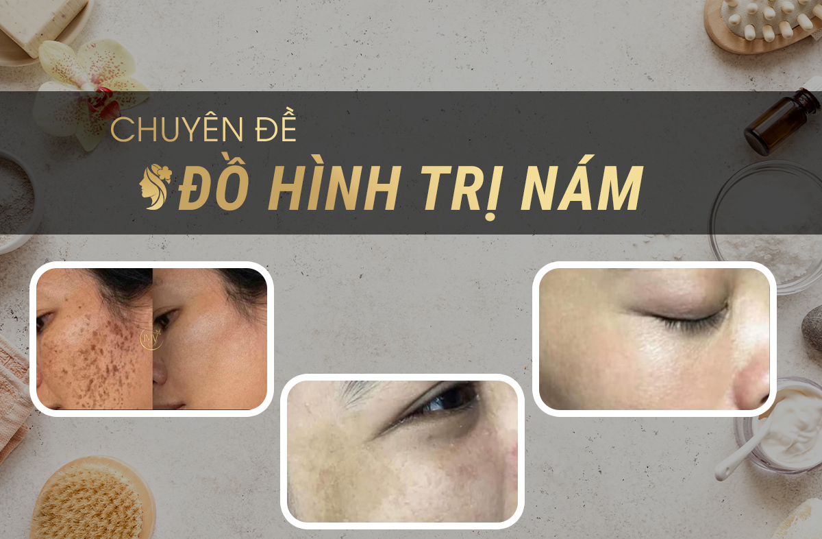 Khóa học trị nám &nbsp; &nbsp; &nbsp; &nbsp; &nbsp; &nbsp; &nbsp; &nbsp; &nbsp; &nbsp; &nbsp; &nbsp; &nbsp; &nbsp; &nbsp; &nbsp; &nbsp; &nbsp; &nbsp; &nbsp; &nbsp; &nbsp; &nbsp; &nbsp;
